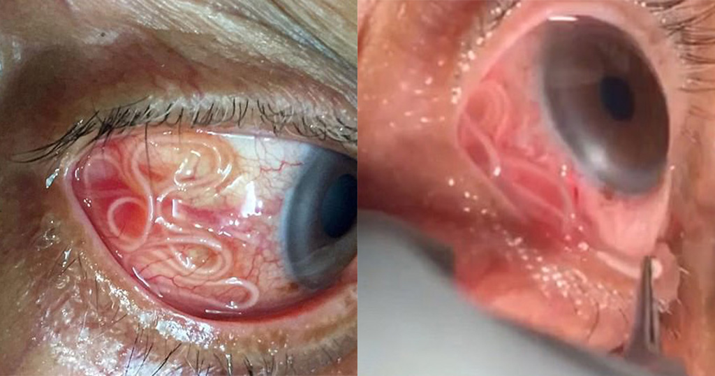 Γιατρός έπρεπε να αφαιρέσει σκουλήκι 15 εκατοστών από μάτι ασθενή! (ΒΙΝΤΕΟ)