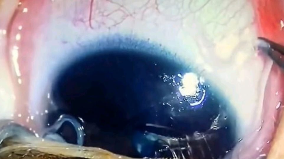 Απίστευτο: Γιατροί έβγαλαν 11 σκουλήκια από το μάτι βρέφους!