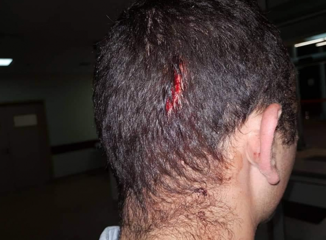 Εικόνες-σοκ: Τα τραύματα των αστυνομικών από την επίθεση των Ρομά στου Ρέντη (ΦΩΤΟ)