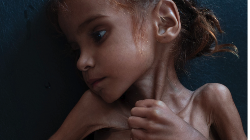 «Έφυγε» από την πείνα η 7χρονη, σύμβολο του λιμού στην Υεμένη