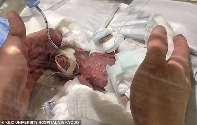 Nίκη της ζωής! Τα κατάφερε το μικρότερο μωρό που γεννήθηκε στον κόσμο, 286 γραμμάρια! (ΦΩΤΟ)