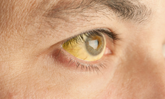 Τι πρέπει να προσέχουμε με τα κίτρινα μάτια