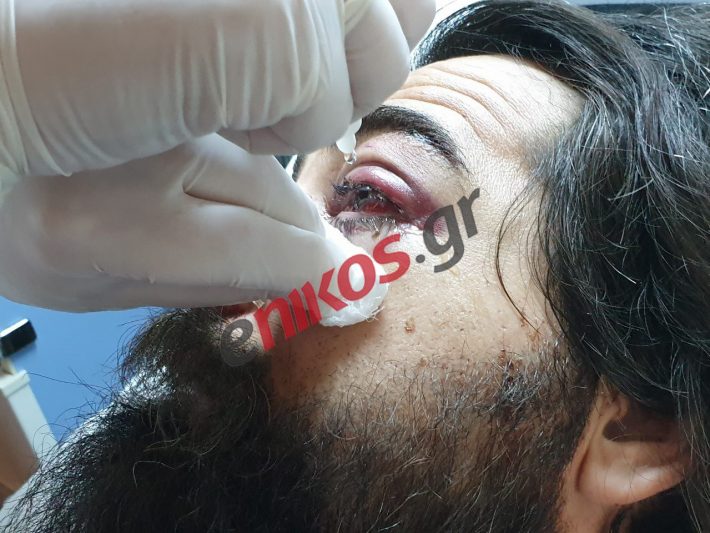 Φωτογραφίες-σοκ του 31χρονου που έχασε το μάτι του στα επεισόδια του ΟΑΚΑ