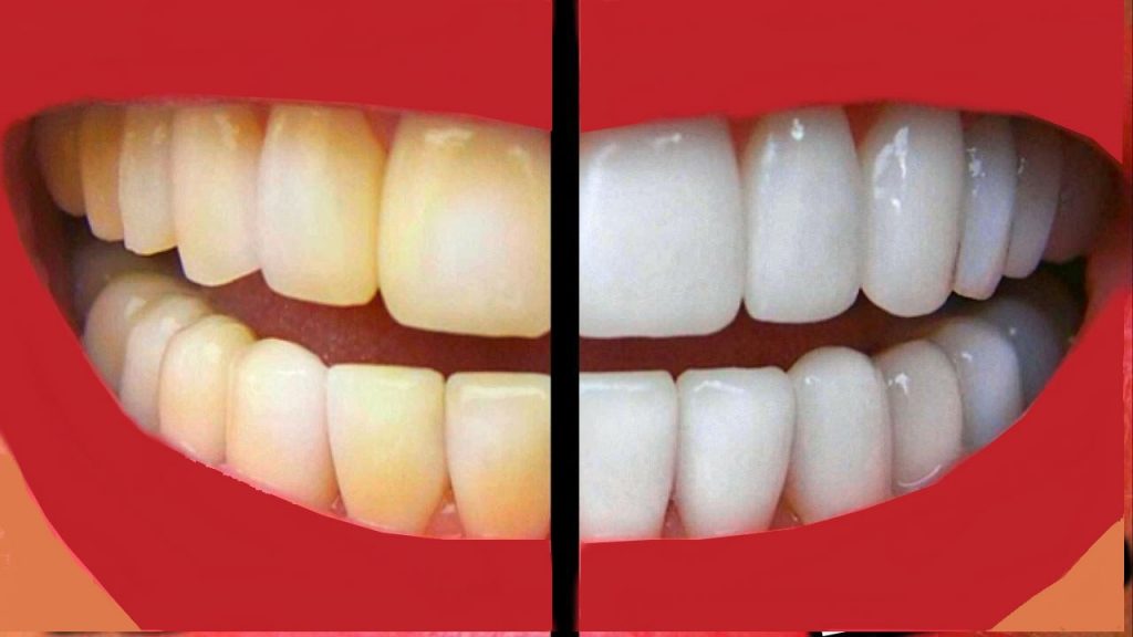 Με αυτό το διάλυμα θα αποκτήσετε πιο αστραφτερά δόντια