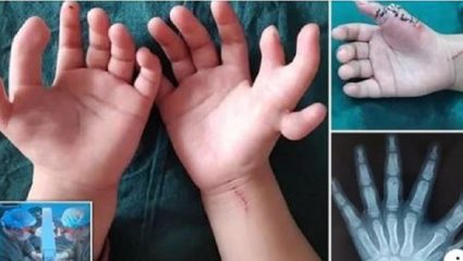 Κοριτσάκι γεννήθηκε με… 14 δάχτυλα! – ΦΩΤΟ Κοριτσάκι γεννήθηκε με… 14 δάχτυλα! – ΦΩΤΟ