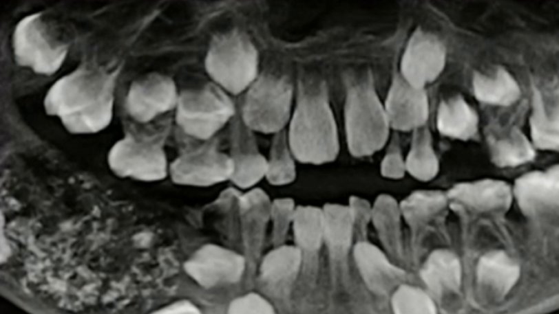 Απίστευτο: 7χρονο αγόρι είχε 526 δόντια μέσα στο στόμα του! (ΒΙΝΤΕΟ)